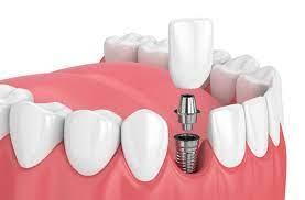 Dental Implants In New Rochelle, NY
